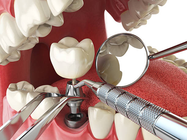 Best Chipped Tooth Repair Near Me  in Point, TX